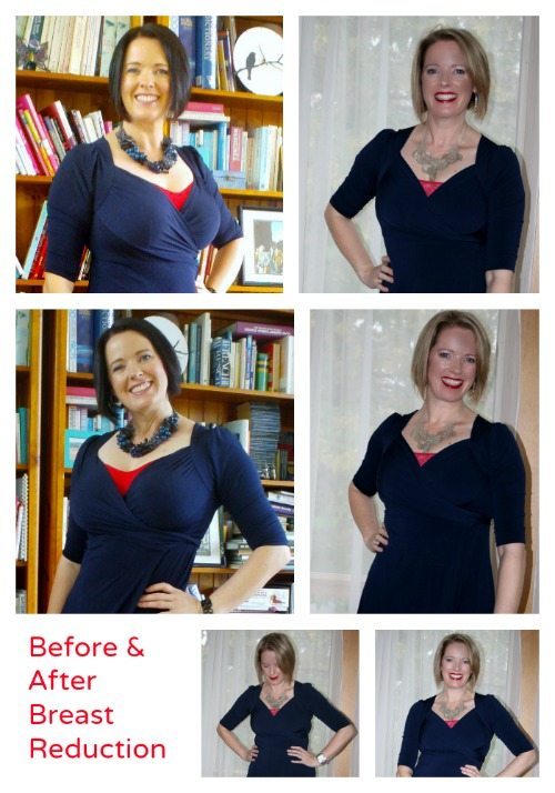 TRYING ON MY CLOTHES AFTER MY BREAST REDUCTION! (before & after