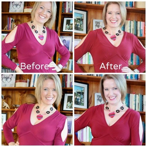 Breast Reduction Update 4 Weeks Post Surgery