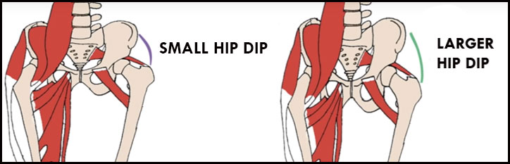 What are hip dips caused by