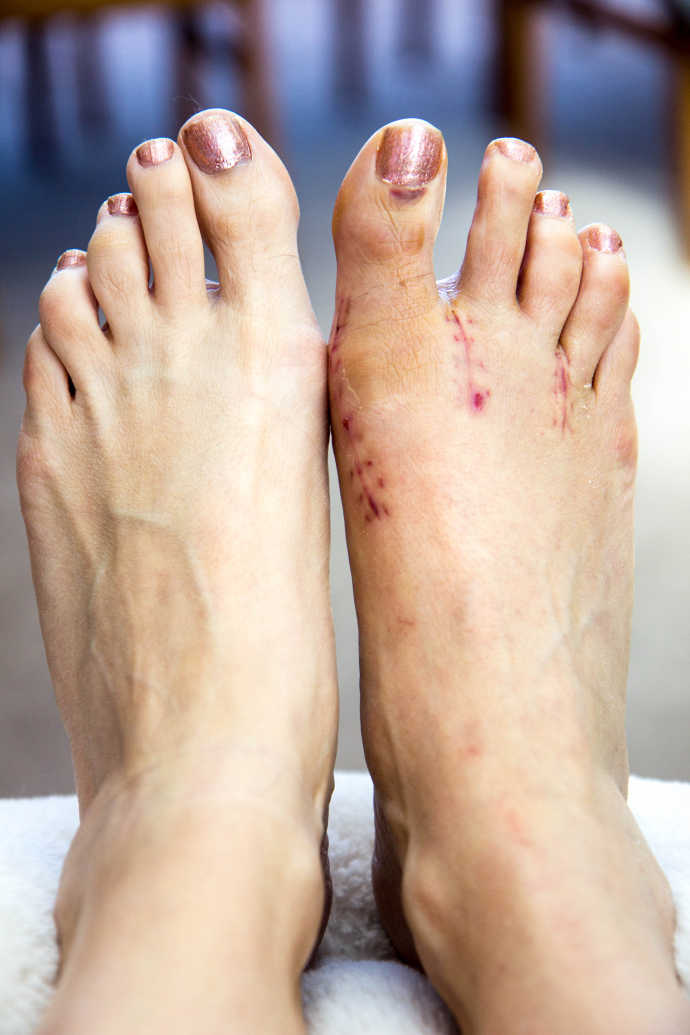 Bunion Surgery Before and After Photos