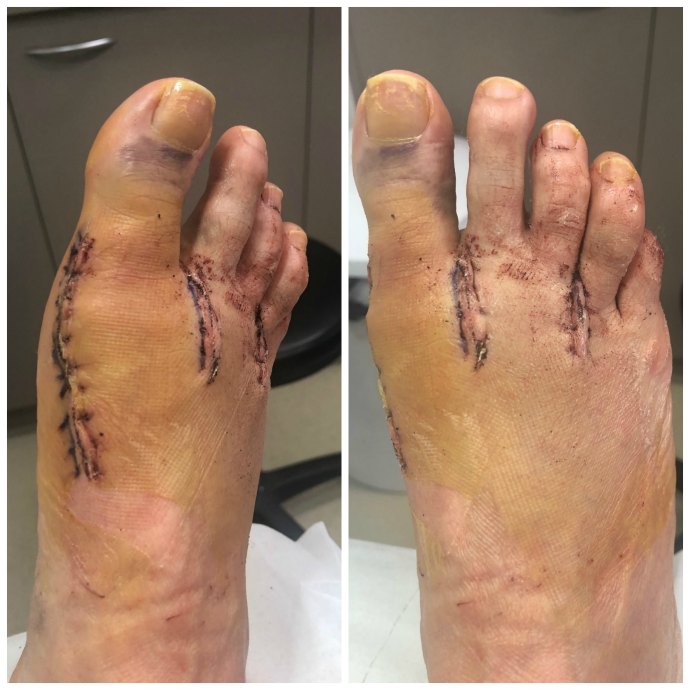 2 weeks post bunion surgery removal of stitches