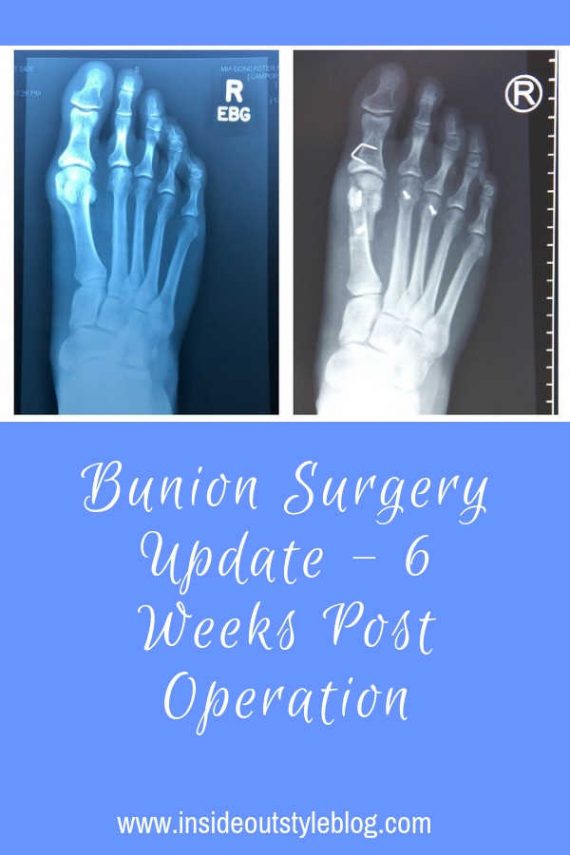 Bunion Surgery Update 6 Weeks Post Operation — Inside Out Style