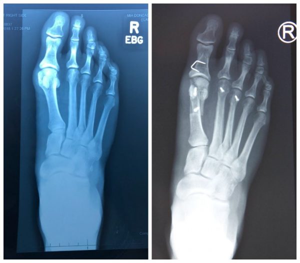 Bunion Surgery Update - 6 Weeks Post Operation — Inside Out Style