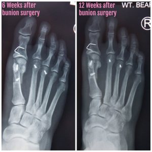 Free to Do as I Please - 3 Month Bunion Surgery Update — Inside Out Style