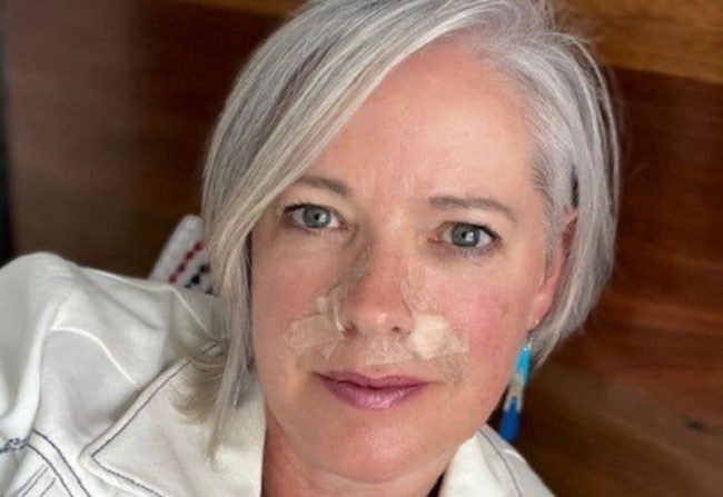 basal cell carcinoma skin cancer diagnosis And then this happened - after a trip to the dermatologist